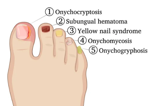 common nail disorders
